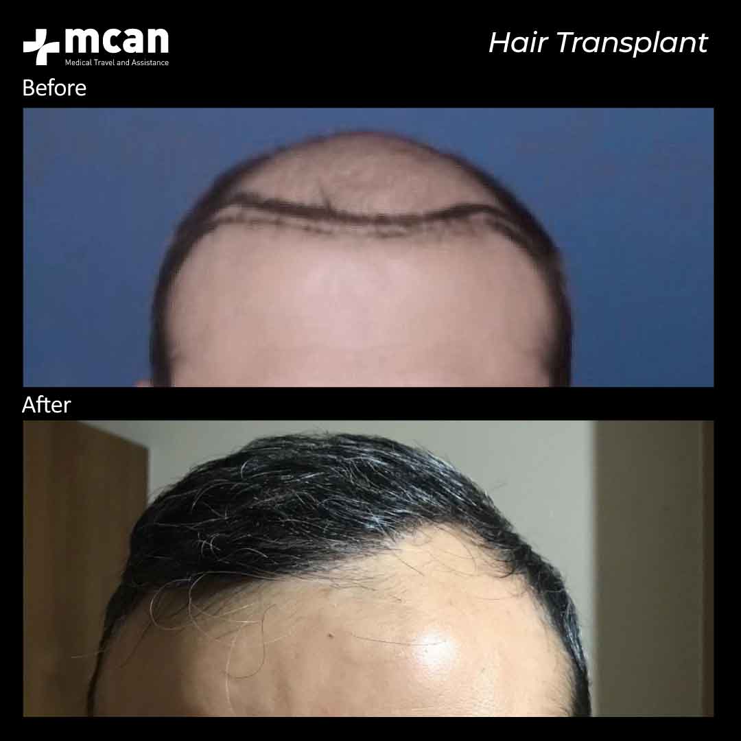 3.12.20 hair transplant before after 1