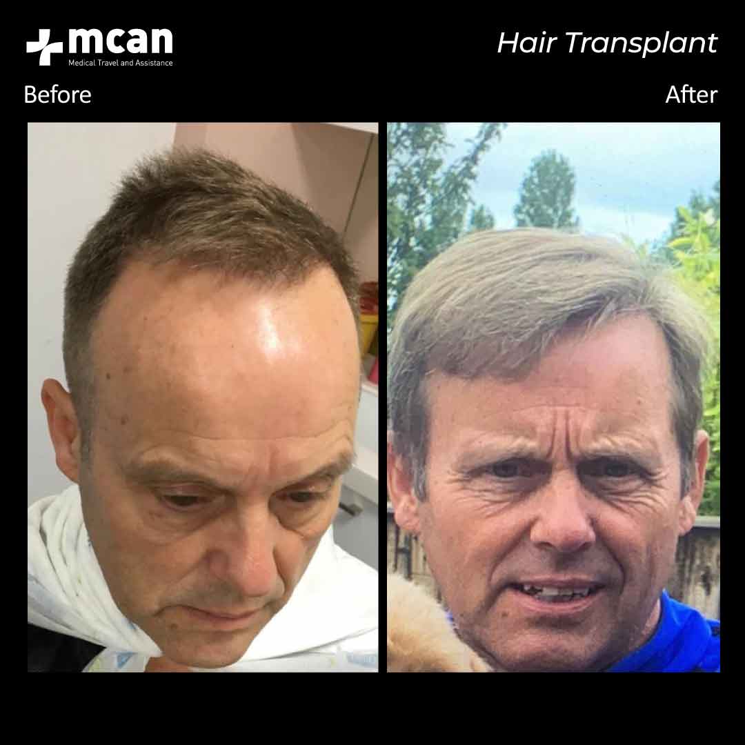 Hair Transplantation Before and After - MCAN Health Hair Transplantation Before and After - MCAN Health