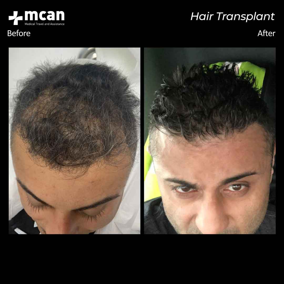 8.12.20 hair transplant before after 1