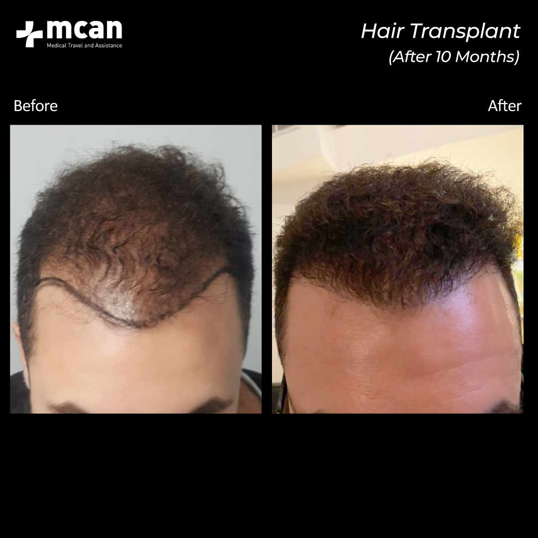 8.12.20 hair transplant before after 2