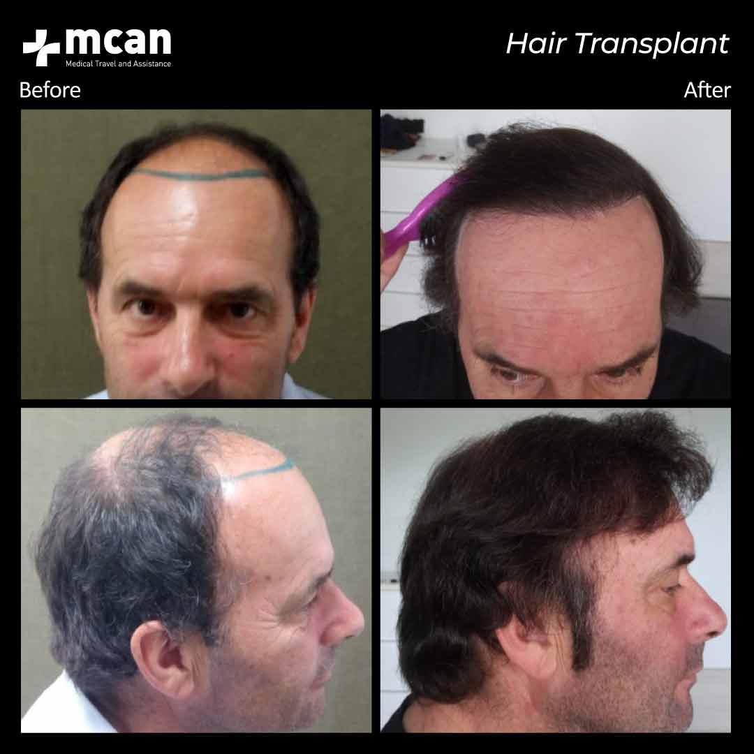 8.12.20 hair transplant before after 3