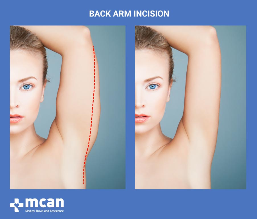 Arm Lift in Turkey-Back Arm Incision