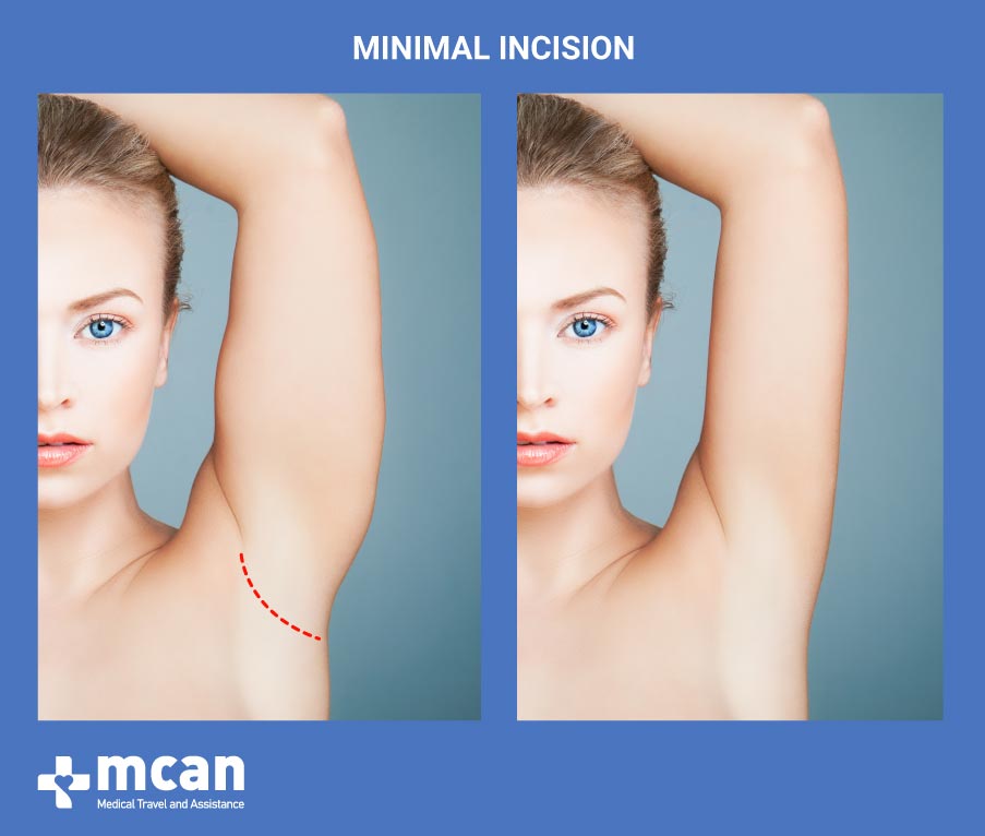 Arm Lift in Turkey-Minimal Incision