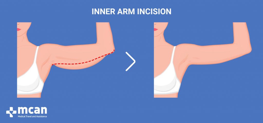 Arm Lift in Turkey - inner arm incision