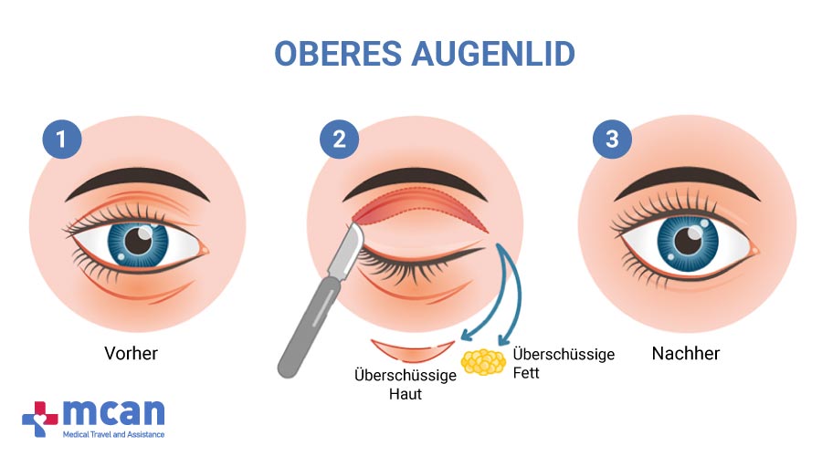 Augenlidstraffung in der Turkei MCAN Health-Oberes Augenlid
