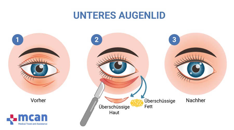 Augenlidstraffung in der Turkei MCAN Health-Unteres Augenlid