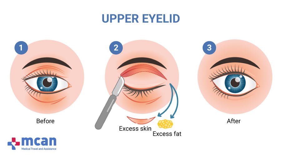 Blepharoplasty in Turkey MCAN Health-Upper Eyelid