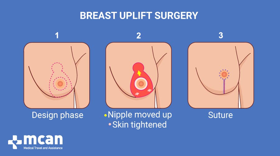 Breast Uplift in Turkey MCAN Health Breast Uplift Surgery