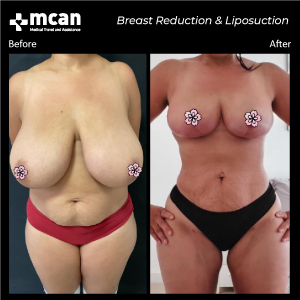 Breast and Liposuction in Turkey Before After MCAN Health