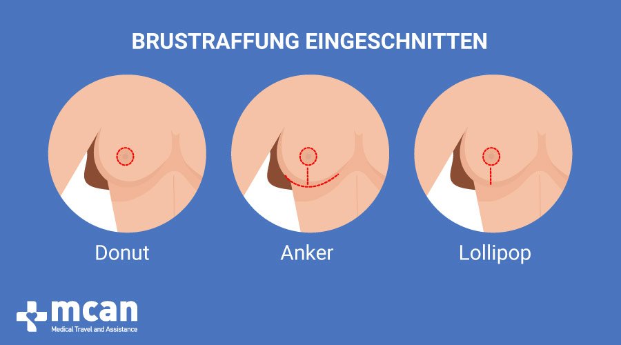 Bruststraffung in der Türkei MCAN Health