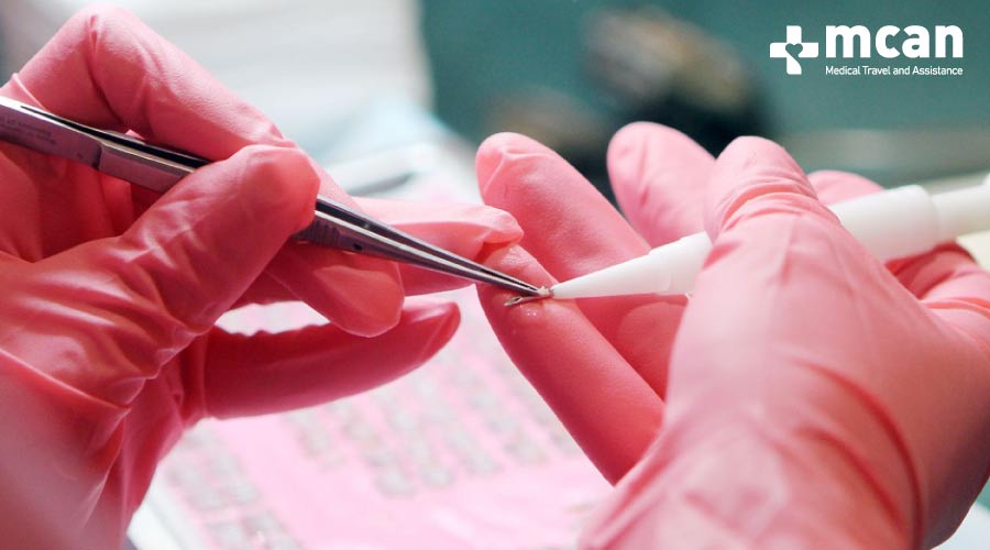 Ручка-имплантер CHOI в методе DHI – Пересадка волос DHI в Турции - MCAN Health