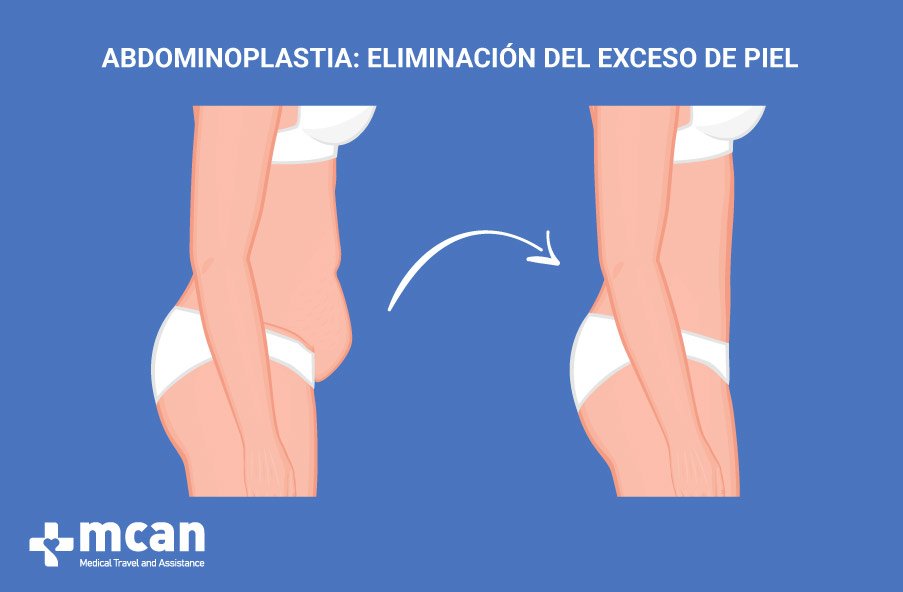 Como se realiza una abdominoplastia