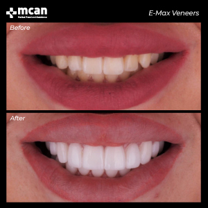 Dentistry in Turkey Before After MCAN Health