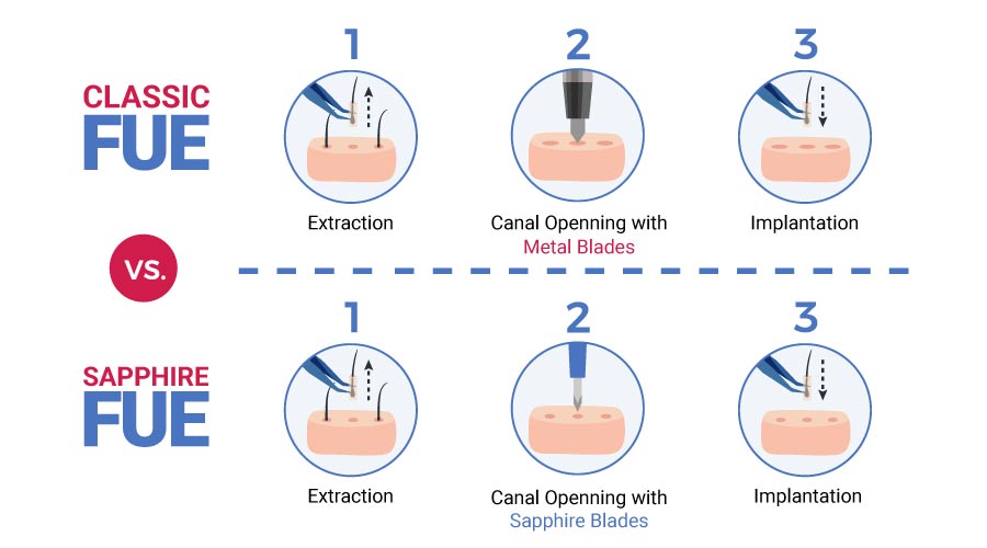 FUE vs Sapphire Hair Transplant