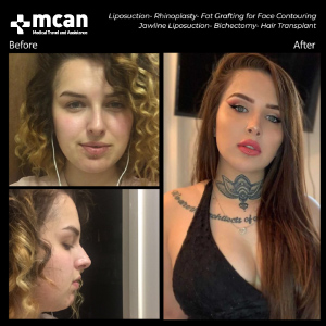 Face Before After MCAN Health