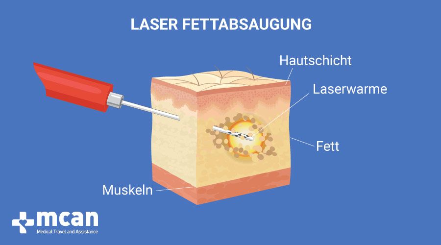 Fettabsaugung in der Türkei Mit erschwinglichen Preisen Ablauf, Kosten