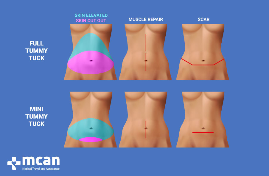 Full and Mini Tummy Tuck in Turkey