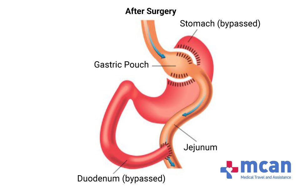 GASTRIC BYPASS TURKEY MCAN HEALTH