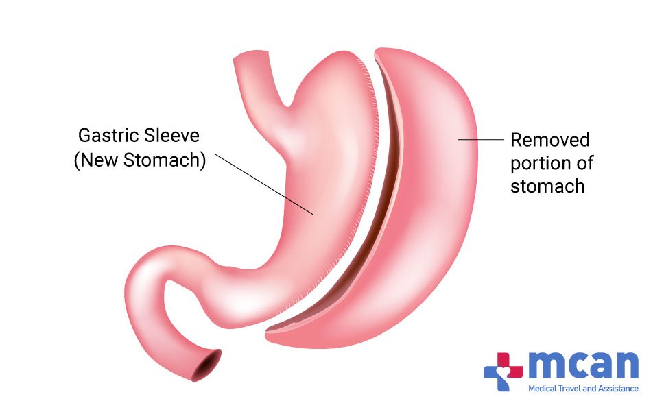 GASTRIC SLEEVE TURKEY MCAN HEALTH