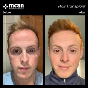 Hair Transplant in Turkey Before After MCAN Health