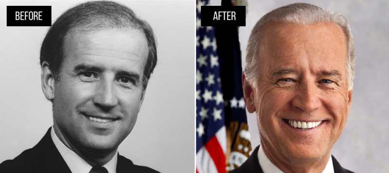 Famous hair transplant before and after Joe Biden
