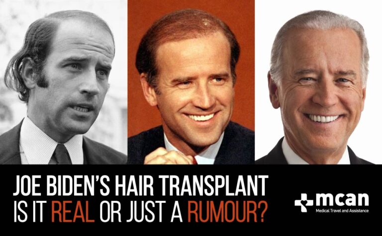 Joe Biden Hair Transplant