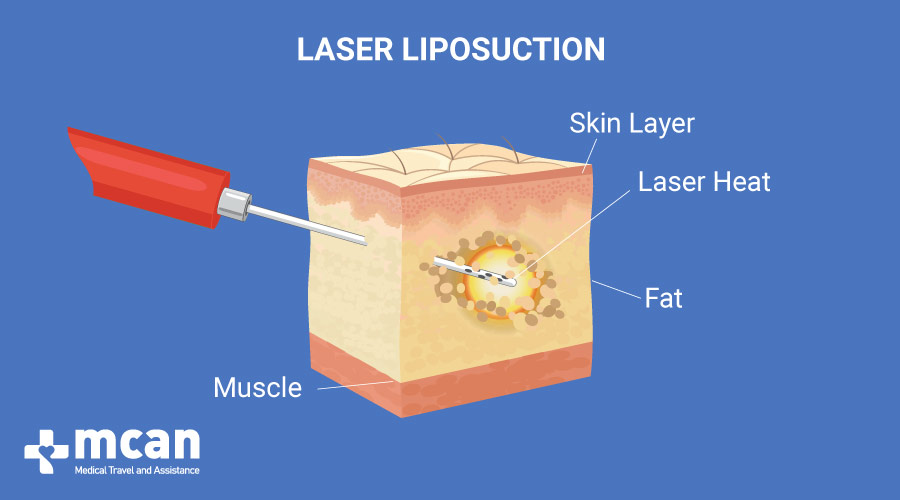 Liposuccion au laser