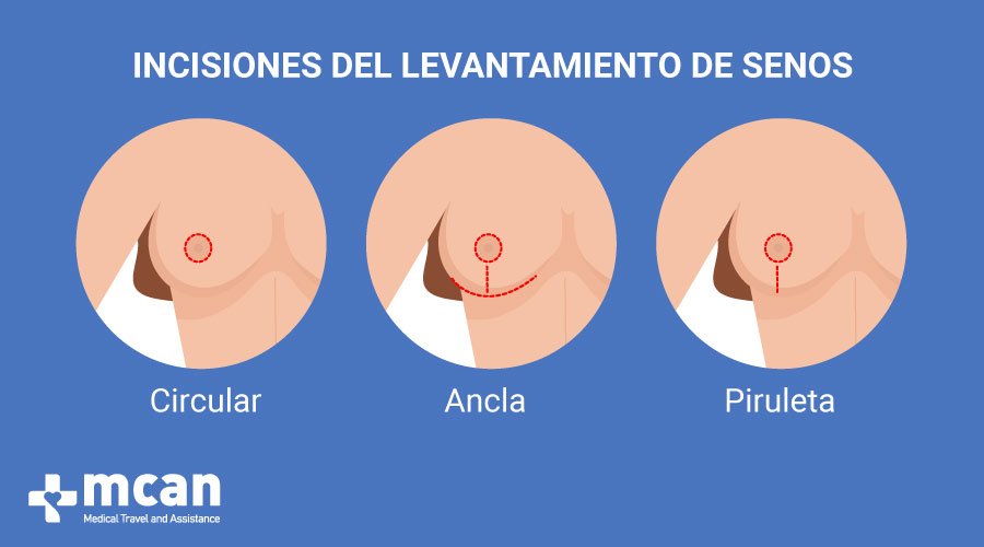 Levantamiento de pechos en Turquia MCAN Health