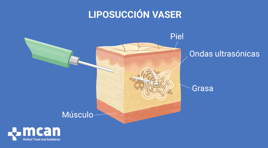 Liposucción en Turquía - Lipo Vaser