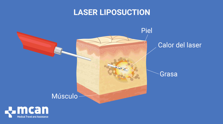 Liposucción en Turquía - Liposucción Láser