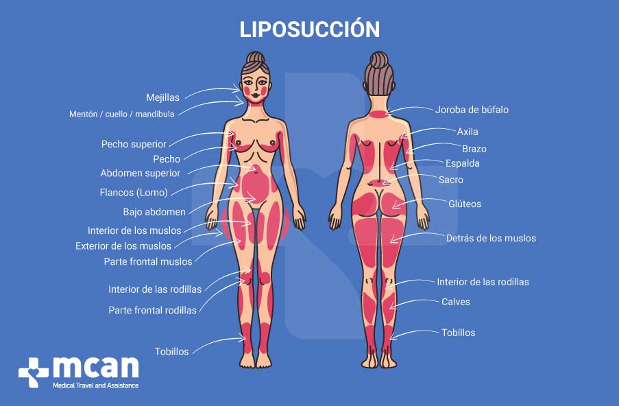 Liposucción en Turquía