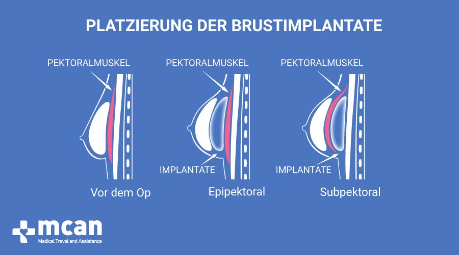MCAN HEALTH Bruestvergroesserung in der Turkei platzierung der brustimplantate