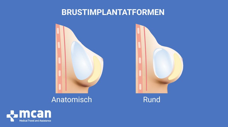 MCAN HEALTH Methoden von Brust Operationen Brustimplantaten in der Turkei