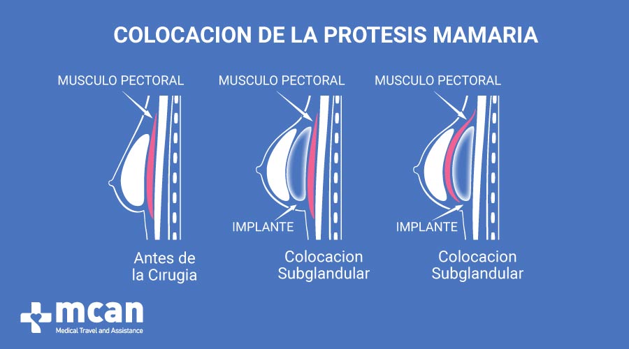 MCAN Health Aumento de pecho en Turquia Colocacion de la protesis mamaria