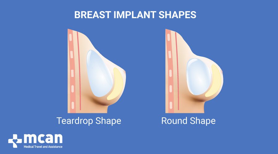 MCAN Health Breast Enlargement in Turkey Methods of Boob Job Breast Implants