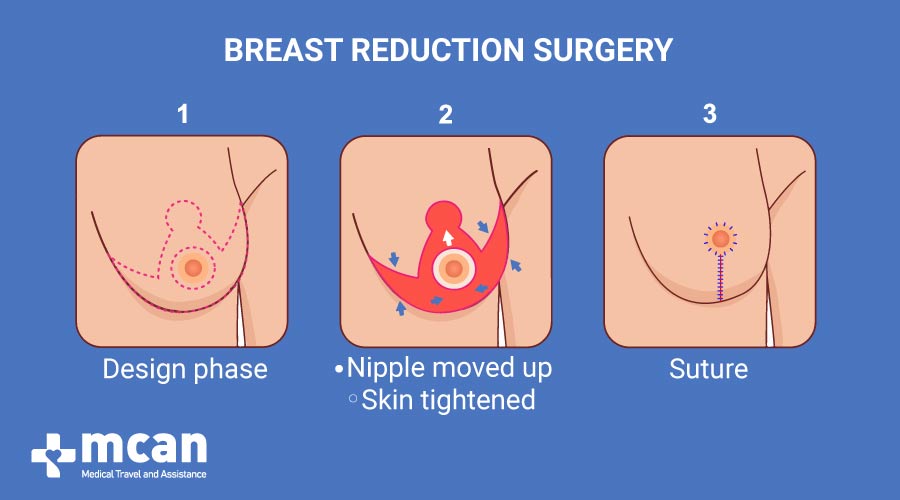 2. Repositionnement des mamelons et retrait des tissus