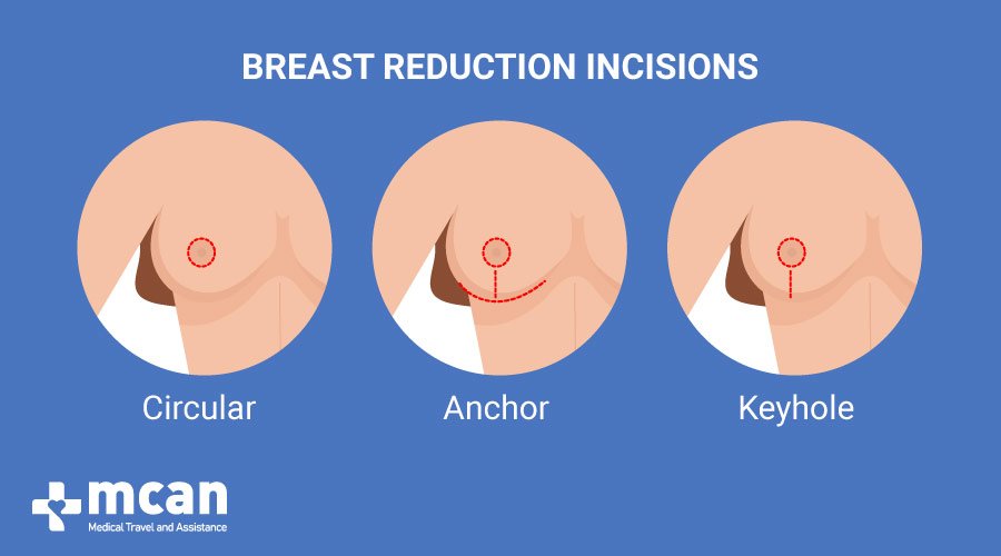 MCAN Health Breast Reduction in Turkey incisions