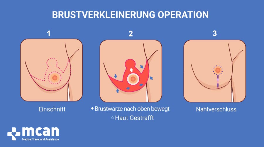 MCAN Health Brustverkleinerung in der Turkei Brustverkleinerung operation