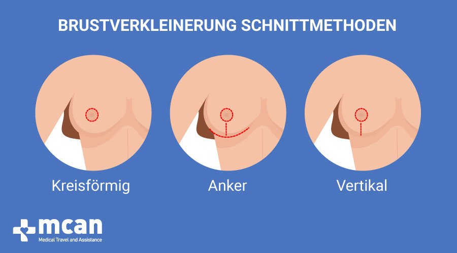 MCAN Health Brustverkleinerung in der Turkei schnittmethoden