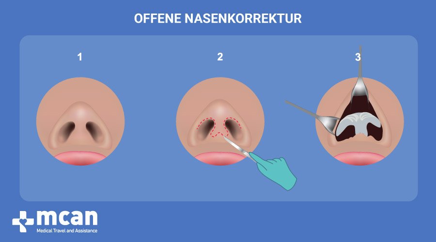 MCAN Health Nasenoperation Turkei Offene Nasenkorrektur