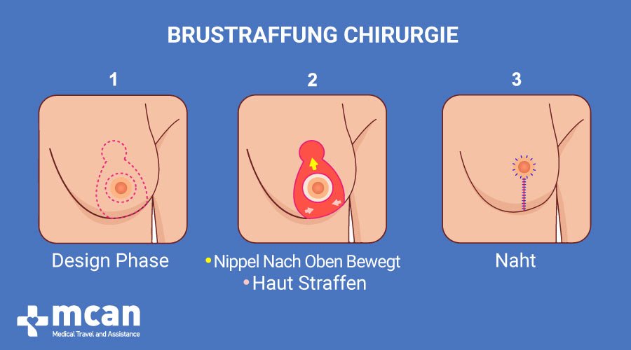 MCAN HealthBruststraffung in der Türkei