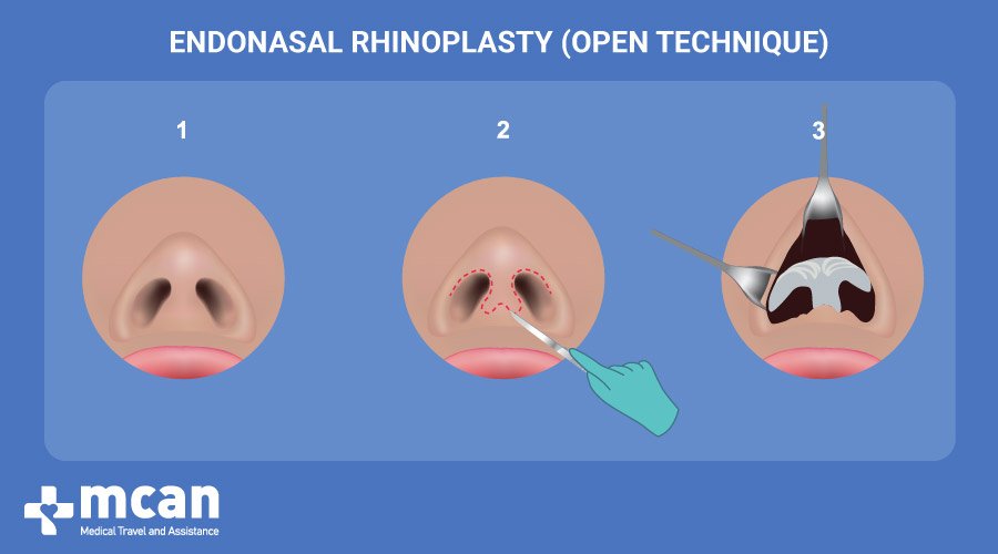 Endonasal rhinoplasty in Turkey | MCAN Health