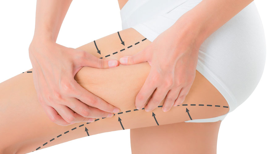 Oberschenkelstraffung Turkei MCAN Health