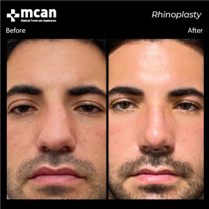 Rhinoplasty in Turkey Before After MCAN Health