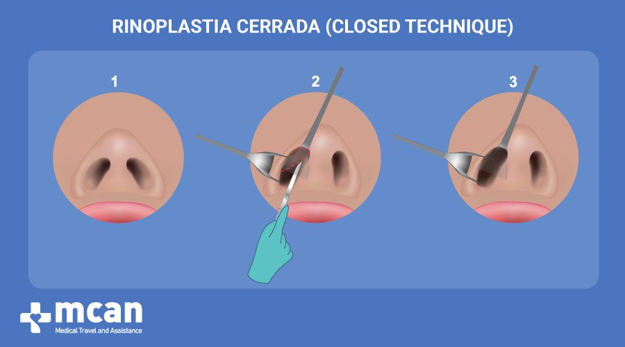Rinoplastia en Turquía- Rinoplastia Cerrada MCAN Health