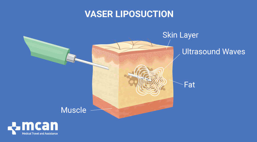 Liposuccion Vaser