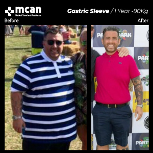 Weightloss in Turkey Before After MCAN Health