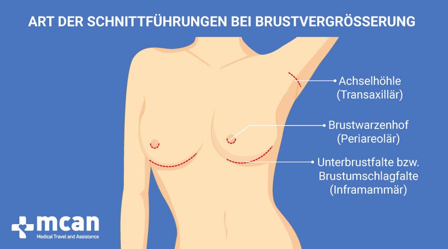 Wie wird die Brustvergrosserung durchgefuhrt