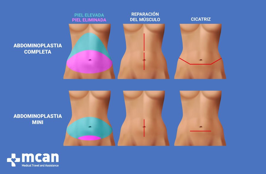 abdominoplastia completa mini