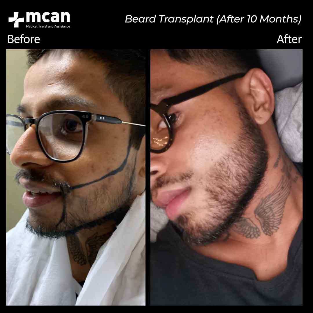 beard transplantation 02